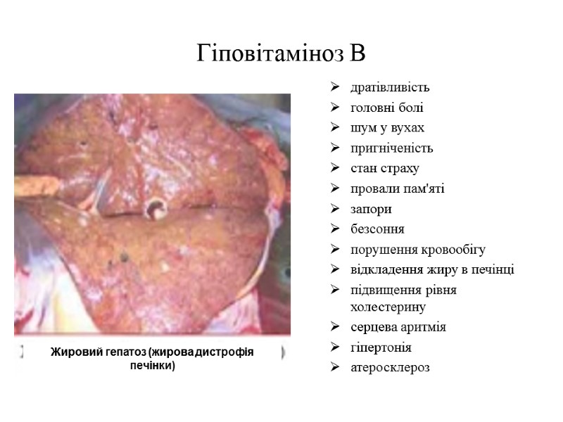 Гіповітаміноз В дратівливість головні болі шум у вухах пригніченість стан страху провали пам'яті запори